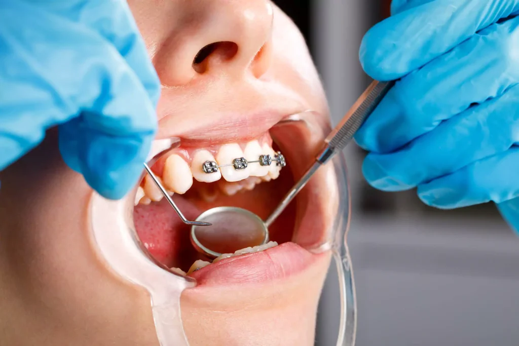 What Is The Best Dental Insurance For Braces