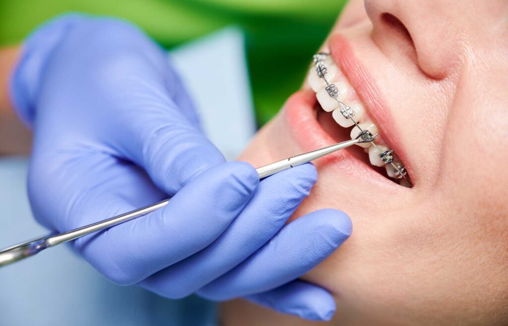 What Is The Best Dental Insurance For Braces