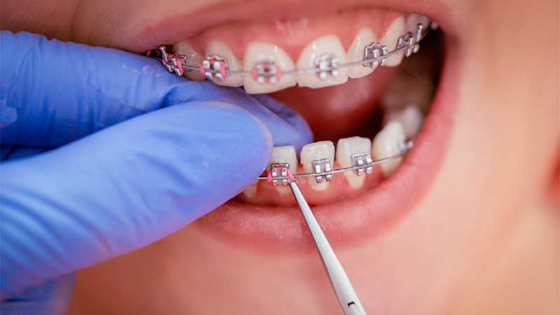 What Is The Best Dental Insurance For Braces